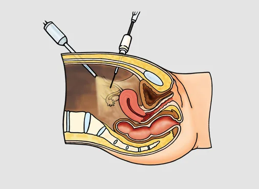 Diagnostic Laparoscopy consultation at Niraaya Hospital